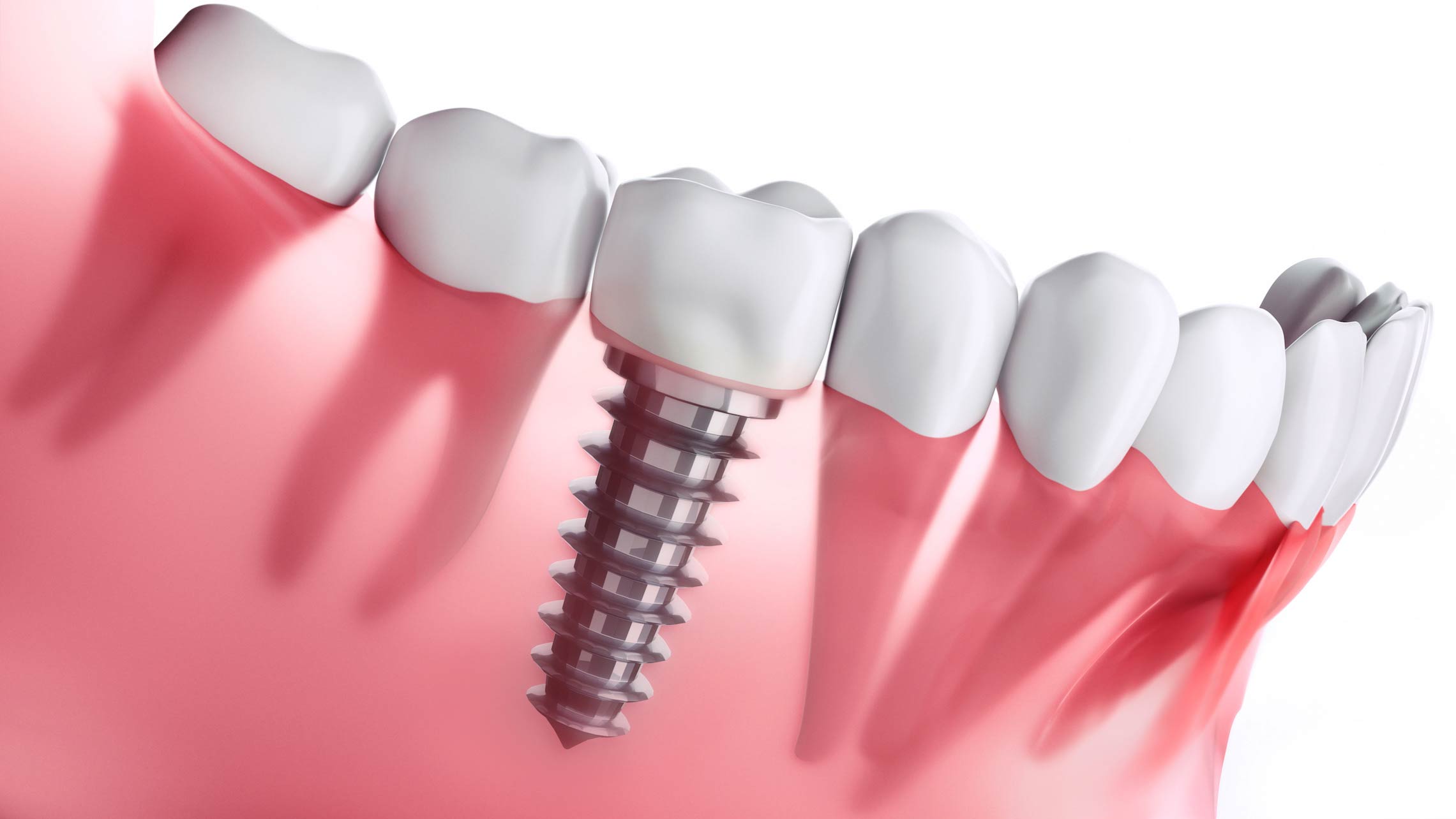Implants Implants