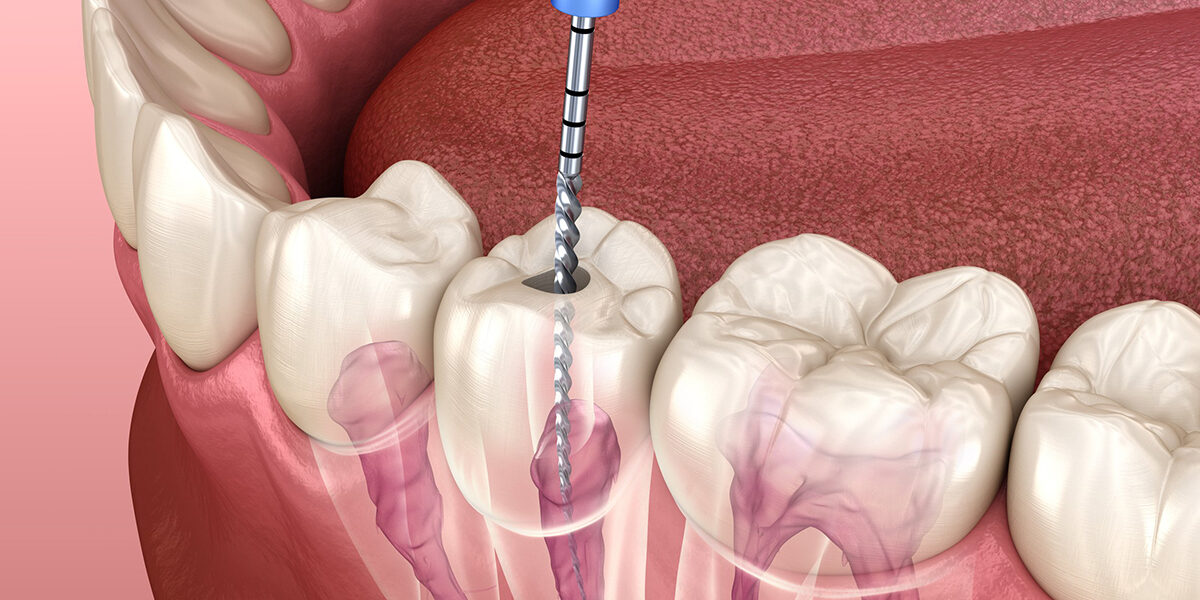 Root Canal Treatments Root Canal Treatments