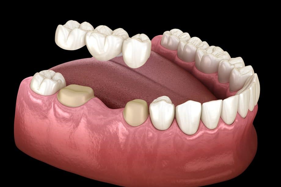 Dental Bridges Dental Bridges